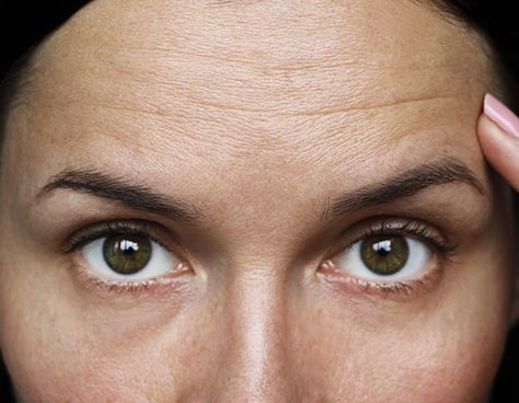 How To Get Rid Of Deep Forehead Wrinkles, Guasha Forehead Wrinkles, Forehead Wrinkles Massage, How To Prevent Forehead Wrinkles, 11 Forehead Wrinkle, Frown Lines, Smile Lines, Forehead Wrinkles, Acne Solutions