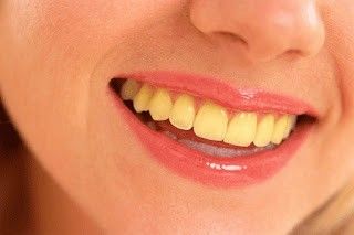 Best Teeth Whitening Kit, Discolored Teeth, Teeth Whitening Remedies, Laser Teeth Whitening, Perfect Teeth, Yellow Teeth, Tooth Enamel, Best Teeth Whitening, Natural Teeth Whitening