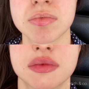 Lip Filler Styles, Wide Lips, Dermal Fillers Lips, Lip Surgery, Lips Inspiration, Face Fillers, Botox Lips, Facial Fillers, Facial Contouring