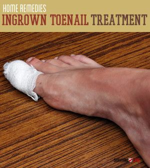 Toenail Fell Off, Nail Falling Off, Medical Tips, Ingrown Toenail, Diy Home Remedies, Nail Infection, Ingrown Toe Nail, Toenail Fungus, Survival Life