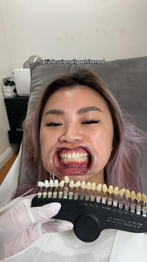 Teeth whitening by a professional🦷 V34 Colour Corrector, Dental Posts, Colour Corrector, Diy Tooth Fairy, Whitening Teeth, Grills Teeth, Lip Care Routine, Dental Humor, How To Prevent Cavities