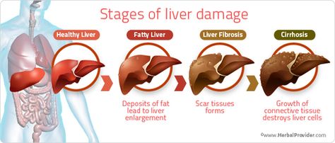 _ When the liver begins to deteriorate, it goes through several stages before eventually resulting in a complete deterioration of the liver. If the signs are recognized early on then a more serious... Liver Cleanse Recipe, Liver Detox Diet, Detox Your Liver, Full Body Detox, Liver Failure, Liver Detox, Healthy Liver, Liver Health, Detox Your Body