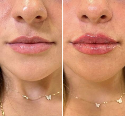 Facial Balancing, Face Injections, Dermal Fillers Lips, Lips Inspiration, Botox Before And After, Face Fillers, Botox Lips, Facial Fillers, Facial Contouring