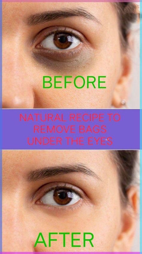 Home Remedies | NATURAL RECIPE TO REMOVE EYE BAGS UNDER remove THE EYES AND DARK CIRCLES Leve bags under the eyes #darkcircles #skin#naturalremedy… | Instagram Brighten Under Eyes, Rid Of Eye Bags, Bags Under Eyes, Remove Eye Bags, Baking Soda Cleaning, Nerve Pain Relief, Under Eyes, Facial Scrubs, Nerve Pain