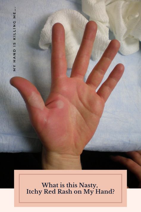 My Hand is Killing Me….What is this Nasty, Itchy Red Rash on My Hand? - Superfoodliving.com Allergic Reaction Rash, Home Remedies For Rashes, Rash On Hands, Itchy Legs, Common Skin Rashes, Swollen Hands, Itchy Hands, Red Rash, Itchy Rash