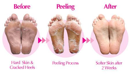 Come and get a foot peel today!  $35.00 for fresh new feet all summer long.  906-225-7126 Skin Care Routine For 20s, Coconut Oil For Skin, Cracked Heels, Cracked Skin, Dry Skin Care, Skin Care Acne, Skin Cream, Better Skin, Simple Skincare