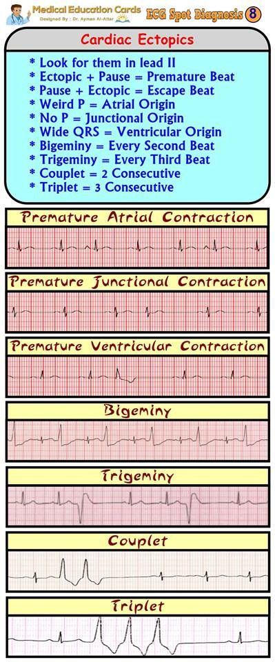 Cardiac Bigeminy Ekg, Cardiology Nursing, Ekg Interpretation, Ecg Interpretation, Paramedic School, Nursing Information, Nursing Fun, Cardiac Nurse, Nursing Mnemonics