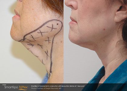 Chin Rejuvenation - OC Center Smart Lipo Smart Lipo, Before And After Pictures, After Photos, Watercolor Tattoo, Male Sketch, Art