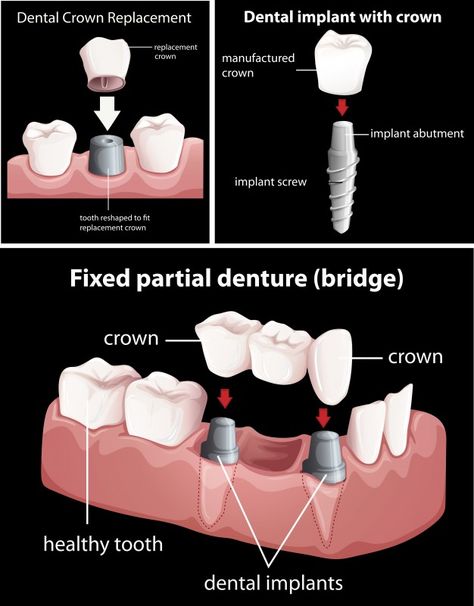 Teeth Whitening Professional, Tooth Extraction Aftercare, Wisdom Teeth Funny, Tooth Extraction Healing, Oral Health Education, Dental Photos, Pediatric Dental Office, Dental Images, Dairy Free Breastfeeding