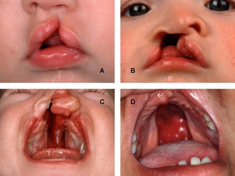 People not understand why repairing cleft palates is so important. PK. unilateral cleft lip - Google Search Polymerase Chain Reaction, Dental Retainer, Cleft Lip And Palate, Cleft Palate, Cleft Lip, Speech Path, Medical Information, Speech Therapy, Surgery