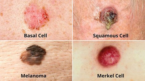 Basal Cell, Squamous Cell, Skin Growths, Types Of Skin, Skin Spots, Types Of Cancers, Dermatology, Skin Cells, Signs