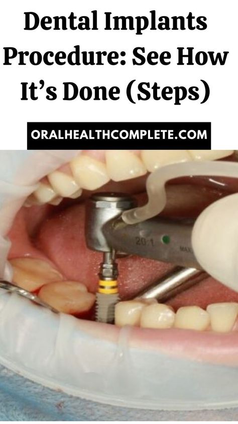 Dental Implants Procedure Dental Implant Procedure, Dental Implants Cost, Dental Implant, Dentures, Dental Implants, The Process, Different Types, Step By Step