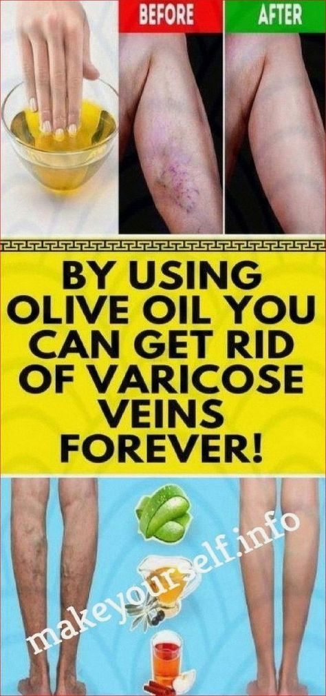 How To Remove Varicose Veins Using The Magic of Olive Oil Cloves Health Benefits, Home Remedies For Allergies, Varicose Vein Removal, Varicose Vein Remedy, Leg Veins, Natural Remedies For Migraines, Dry Skin Remedies, Medical School Essentials, Herbs For Health