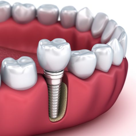 Many of our dentists have advanced training in dental implants, braces and prosthodontics. This training and experience bring about confidence and skill to help you achieve your dream smile. #JonathanPenchas #MidtownDentistry #HoustonTX #DentalImplant Dental Dentures, Dental Posters, Implant Dentistry, Medical Training, Dental Art, Tooth Sensitivity, Dental Cosmetics, Dental Crowns, Dental Procedures