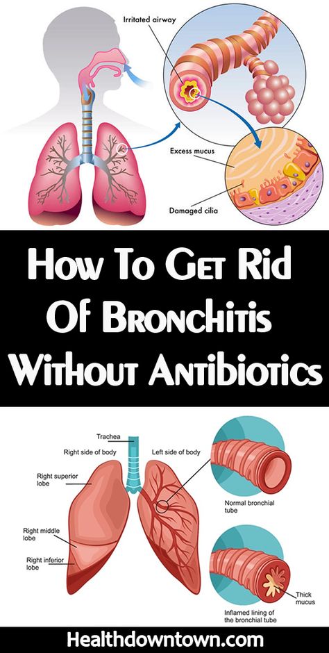 Remedies For Bronchitis, Home Remedies For Bronchitis, Sinus Congestion Relief, Top 10 Home Remedies, Congestion Relief, Sinus Congestion, Chest Congestion, Health Podcast, Natural Cough Remedies