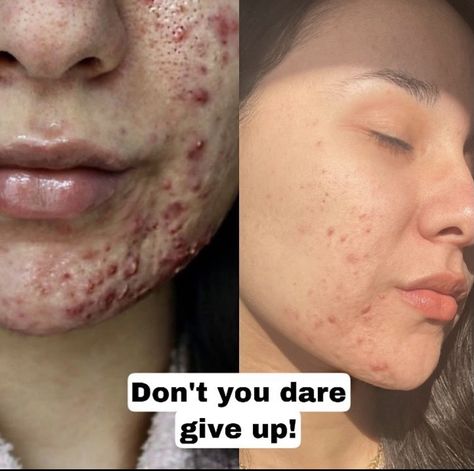 Acne Representation, Acne Is Normal, Strawberry Freckles, Acne Awareness, Dark Joke, Remedies For Pimples, Acne Positivity, Get Rid Of Pimples Overnight, Rid Of Pimples Overnight