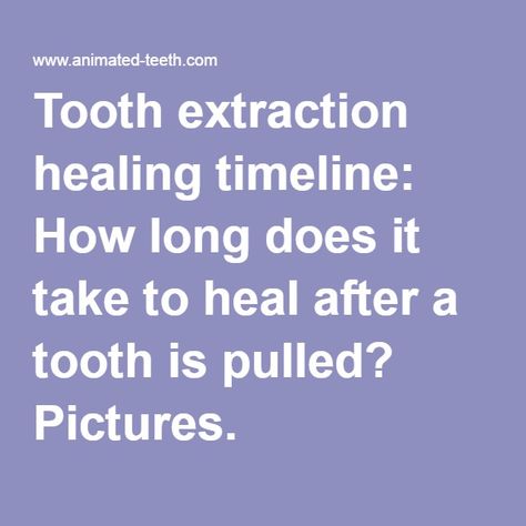 Tooth extraction healing timeline: How long does it take to heal after a tooth is pulled? Pictures. Animated Teeth, Tooth Extraction Aftercare, Wisdom Teeth Funny, Tooth Extraction Healing, Dental Extraction, Teeth Whitening Pen, Implant Dentistry, Teeth Implants, Tooth Extraction