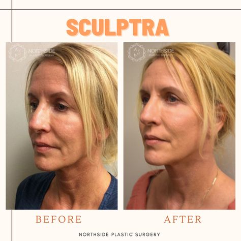 Facial Swelling, Sculptra Aesthetic, Facelift Before And After, Liquid Facelift, Face Lift Surgery, Wrinkle Filler, Facial Tissues, Facial Aesthetics, Under The Skin