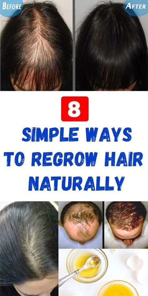 8 Tips to Naturally Regrow Your Hair Faster Regrow Hairline, Regrow Hair Naturally, Hair Growing Tips, Hair Remedies For Growth, Home Remedies For Hair, Regrow Hair, New Hair Growth, Hair Control, Grow Hair Faster