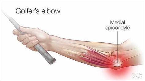 DEAR MAYO CLINIC: Earlier this spring, I developed pain in my wrist and on the inside of my elbow after [...] Elbow Exercises, Ulnar Nerve, Golfers Elbow, Forearm Muscles, Muscle Stretches, Elbow Braces, Elbow Pain, Back Stretches For Pain, Back Pain Remedies