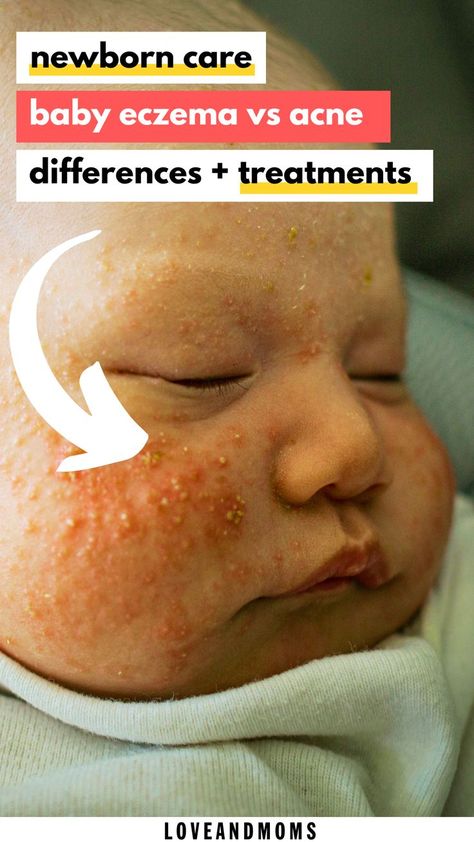 baby acne Newborn Rash On Face, Baby Acne Remedy How To Get Rid Of, Baby Acne Remedy Breastmilk, Baby Excema, Newborn Skin Peeling, Newborn Dry Skin, Baby Acne Remedy, Newborn Acne, Acne Home Remedies