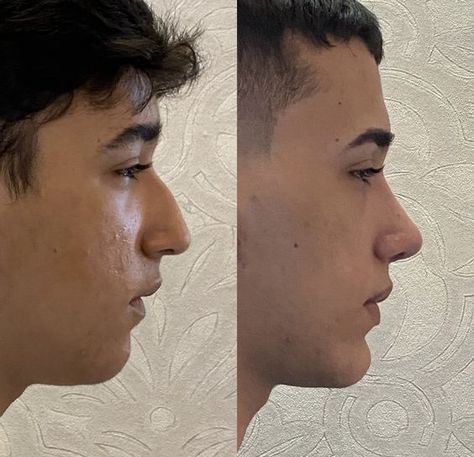 Aqualine Nose Men, Men Nose Job, Straight Nose Men, Kpop Plastic Surgery, Jaw Reduction Surgery, Upturned Nose, Plastic Surgery Fail, Rhinoplasty Nose Jobs, Face Surgery