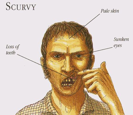 Scurvy was a disease that that was caused due to a lack of vitamin c, this killed many sailors, and since many people sailed in order to trade, many of them were affected. Scurvy Disease, Real Pirate Ships, Diseases Pictures, Famous Pirates, Loose Tooth, Captain Cook, Pirate Life, Medical History, Pale Skin