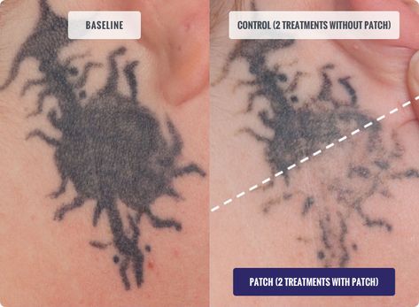 Faster Tattoo Removal With The DESCRIBE Patch Removing Tattoos, Get Faster, Laser Removal, Laser Tattoo, Williamsburg Va, Laser Tattoo Removal, Tattoo Removal, Knoxville Tn, Get A Tattoo