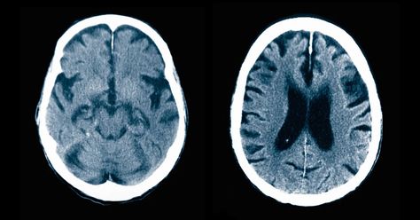 Millions of older adults likely have minor memory issues that can later become dementia. But only a fraction of them are diagnosed early enough for new treatments to stand a chance. Memory Issues, Dog Illnesses, Cognitive Impairment, Types Of Diseases, Brain Scan, Social Research, Respiratory Illness, Memory Problems, Sick Dog