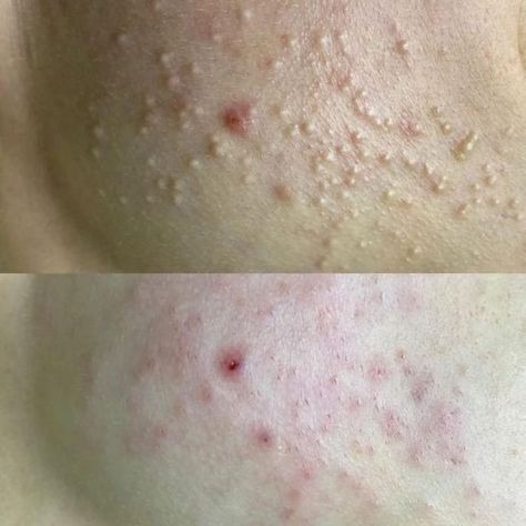 (20+) CLOSED COMEDONES often referred to as... - The Facialist Ballarat | Facebook Closed Comedones, The Skin, Skin Color, Skin, Red, Beauty, Color