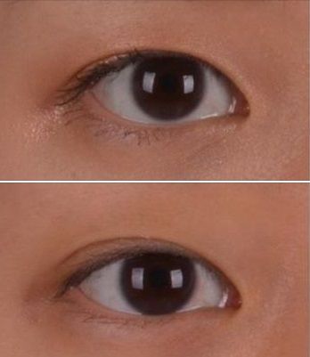 Monolid Vs Double Eyelid, Double Lid Eye, Forehead Lift, Eye Images, Upper Eyelid, Double Eyelid, Brow Lift, Under Eyes, Eye Surgery