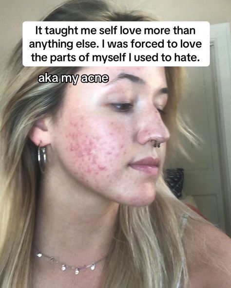 Thank you, acne 🤍. #adultacne #pcosacne #clearskin #glassskin #acnepositivity #acneneutrality Acne Awareness, Acne Journey, Glass Skin, August 15, Clear Skin, Self Care, Self Love, Acne, Skin Care