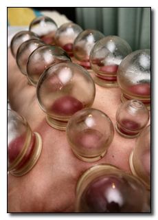 Glass Cupping Therapy, Chinese Alchemy, Chinese Cupping, Hijama Cupping, Fire Cupping, Acupuncture Benefits, Cupping Massage, Complementary Medicine, Cupping Therapy