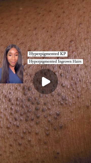 Dr Kemi Fabusiwa on Instagram: "Hyperpigmentation left behind by KP and ingrown hairs?? You DON’T have to settle for that uneven skin tone. ✨💖✨

Here’s my little recipe for smoother, more even-toned skin:

1️⃣ Exfoliate: Salicylic acid is your BFF here! It gently sloughs off dead skin cells, unclogs pores, and helps fade those pesky dark spots.

2️⃣ Brighten & Moisturize: A glycolic acid product with shea butter is the dream team! It exfoliates deeper to reveal brighter, smoother skin while the shea butter keeps your skin hydrated and happy. 🧈💖

3️⃣ Renew: A retinoid body moisturizer is a game-changer! It speeds up cell turnover, fading dark spots and preventing new ones from forming. But start slow and wear your SPF, okay? 🧴💖

#skincare #KP #hyperpigmentation #melaninskin #skincarero Face Discoloration, Back Hyperpigmentation, Hyperpigmentation Body Scrub, Brighter Skin, Dark Spots On Legs Remove, Dark Areas On Body Skin, Hyperpigmentation Black Skin Products, Body Hyperpigmentation, Treat Hyperpigmentation