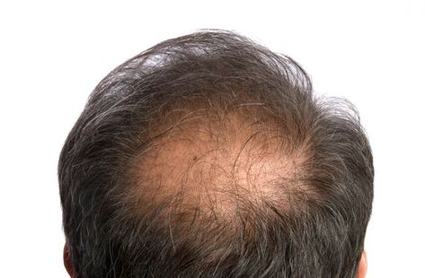 10 things you need to know about male hair loss  #mensstyle #mensfashion #fashion #tshirt #grooming #mensgrooming #menswear #hairstyles #menshairstyles #menshair Baldness Solutions, Male Hair, Male Pattern Baldness, Hair Growth Shampoo, Bald Spot, Pattern Baldness, Regrow Hair, Hair System, Lost Hair