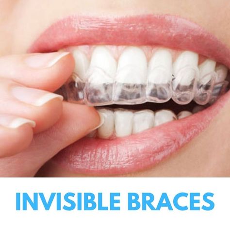 You are not a fan of wearing the old traditional metal braces, Dentist in maroubra brings in another option that might just work for you. Invisible braces are a series of removable and virtually invisible clear aligners which gently move and straighten your teeth over time. Invisalign transparent braces straighten your teeth using a series of invisible custom-moulded, removable aligners. Invisible Braces Teeth, Transparent Braces, Braces Dentist, Fixed Braces, Invisalign Aligners, Invisible Braces, Front Teeth, Clear Aligners, Dental Marketing