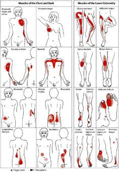 Back Trigger Points, Myofascial Pain Syndrome, Full Body Exercises, Referred Pain, Manual Therapy, Anatomy Medical, Trigger Point Therapy, Trigger Point, Body Exercises