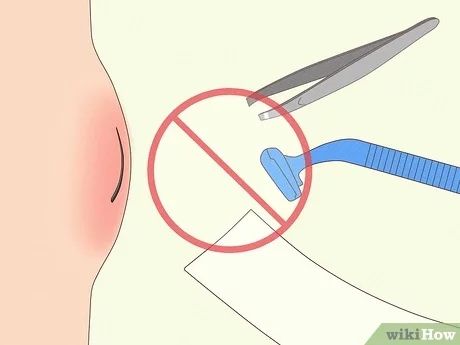 3 Simple Ways to Remove Deep Ingrown Hairs - wikiHow How To Remove Ingrown Hair, Essential Oil For Boils, Infected Ingrown Hair, Treat Ingrown Hair, Ingrown Hair Remedies, Dental Tips, Ingrown Hair Removal, Ingrown Hairs, Hair Curling