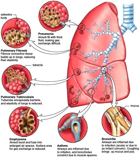 Restrictive Lung Disease | Figure 14.10 Common bronchial and pulmonary diseases. Exposure to ... Family Nurse Practitioner, Pulmonology, Nursing School Survival, Respiratory Care, Respiratory Therapy, Nursing School Studying, Medical School Studying, Nursing School Notes, Human Anatomy And Physiology