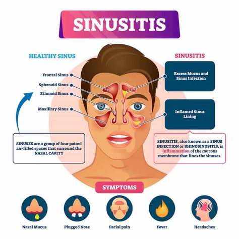 Sinus Headache Remedies, Sinus Inflammation, Remedy For Sinus Congestion, Sinus Drainage, Mucus Plug, Home Remedies For Sinus, Maxillary Sinus, Sinus Congestion Relief, Chronic Sinusitis