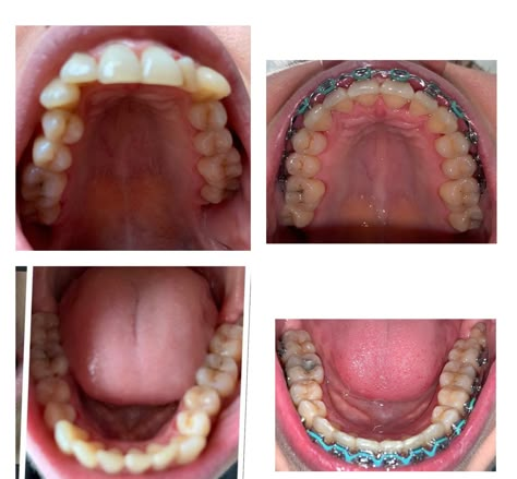 Perfect Teeth Braces, Before And After Braces, Braces Journey, Dental Animation, After Braces, Adult Braces, Brace Face, Dental Braces, Perfect Teeth