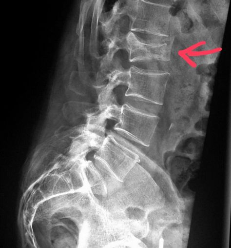 #Lumbar #spine #xray shows a #compression #fracture in an #elderly #patient who #fell. #radiologist #radiology #trauma #pain #injury Lumbar Spine Xray, Spine Xray, Spine Injury, Pro Football Teams, Lumbar Spine, Buddha Image, Coors Light Beer Can, Radiology, X Ray