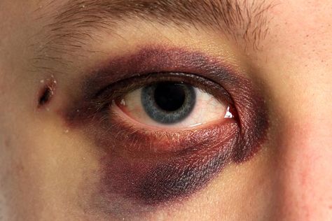 Injury Makeup, Droopy Eyelids, Makeup Class, Fx Makeup, Stage Makeup, Sfx Makeup, Zombie Halloween, Special Effects, Eye Black