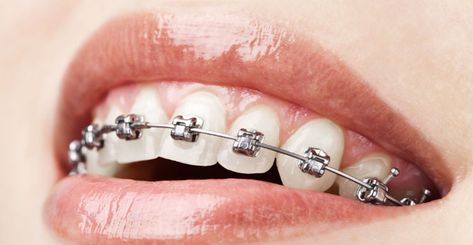 What Are Damon Braces? Clove Dental, Damon Braces, Types Of Braces, Orthodontics Braces, Dental Braces, Metal Braces, Teeth Braces, Dental Bridge, The Teeth