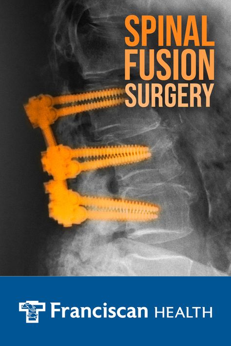 Spinal fusion is a surgical procedure where the vertebrae are held together using screws and rods to heal and fuse as one stable bone. While it might sound scary, it can be necessary for improving chronic back pain. Learn when a spinal fusion is needed, how to prepare for the procedure and see what recovery is like. Spinal Fusion Surgery, Chronic Back Pain, Spinal Fusion, Post Surgery, Sports Medicine, Body Health, Back Pain, Surgery