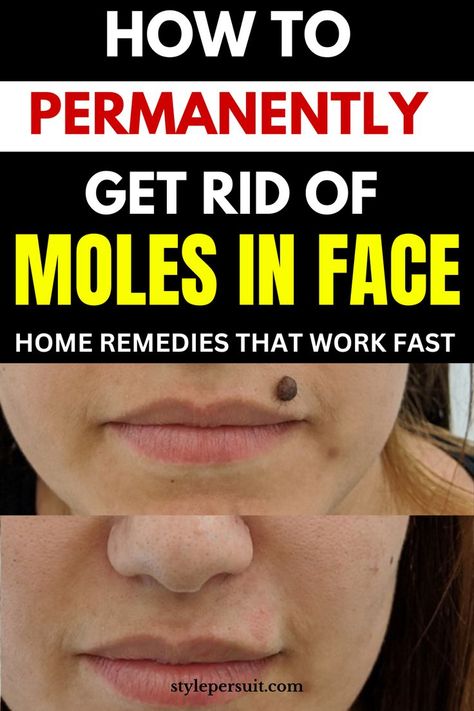 Dealing with moles on the face can be concerning for many individuals, but there are several options available to address them. Here's a guide on how to get rid of moles on the face: Get Rid Of Moles On Face, Removal Of Moles On Face, Remove Moles At Home, How To Remove A Mole On Face, Women With Moles On Face, Removing Moles Naturally, How To Get Rid Of Moles On Skin, How To Get Rid Of Moles, How To Remove Moles From Face