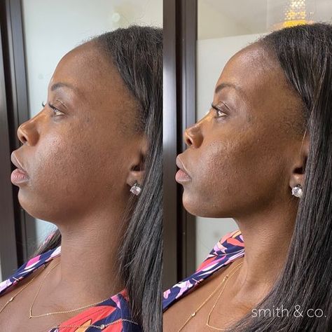 jawline contour — Miami Beach Botox Specialist Chin Botox Before And After, Botox For Jowls, Kybella Before And After, Botox Jawline Before And After, Botox Before After, Jawline Contour, Jawline Contouring, Chin Wrinkles, Perfect Jawline