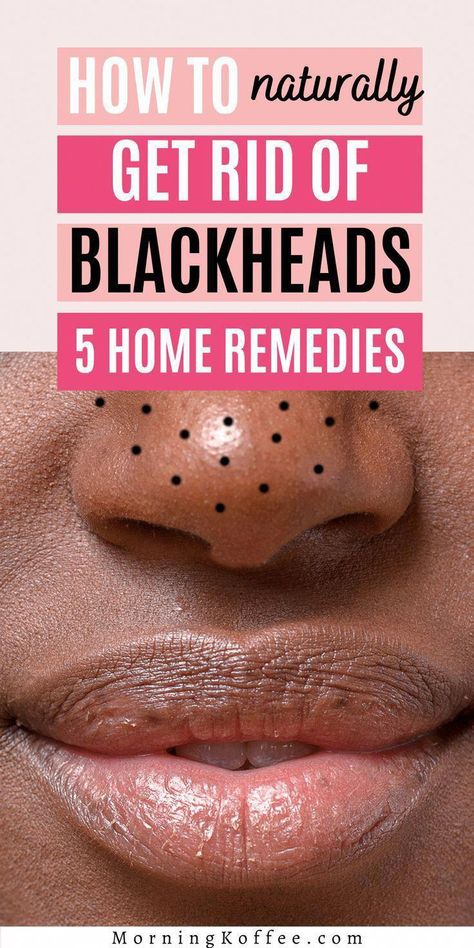 How to clear off blackheads quickly? Here is a post on how you can get rid off blackheads naturally and quickly that are worth to try. #NaturalHomeRemediesForCough #ColdSoreRemedies Ways To Remove Blackheads, Blind Pimple, Pimples Under The Skin, To Remove Blackheads, Rid Of Blackheads, Acne Overnight, Pimples Remedies, Home Remedy For Cough, Blackhead Removal