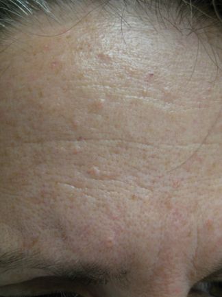 Sebaceous hyperplasia | Common skin lesions | SkinVision Blog Skin Conditions Pictures, Skin Bumps On Face, Skin Disease Pictures, Sebaceous Hyperplasia, Moles On Face, Seborrheic Keratosis, Flat Warts, Facial Warts, Skin Lesions