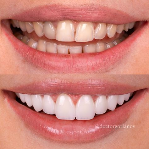 Best Veneers Teeth, Perfect Teeth Smile, Emax Veneers, Perfect Smile Teeth, Dental Makeover, Teeth Veneers, Teeth Aesthetic, Pretty Teeth, Botox Lips